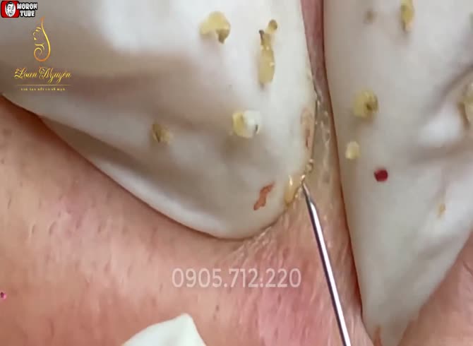 Video :It eliminates blackheads very quickly